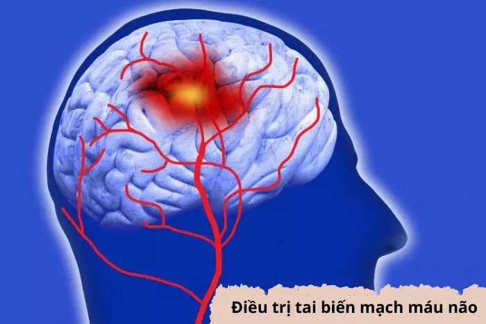 Điều trị tai biến mạch máu não và cách phục hồi di chứng 